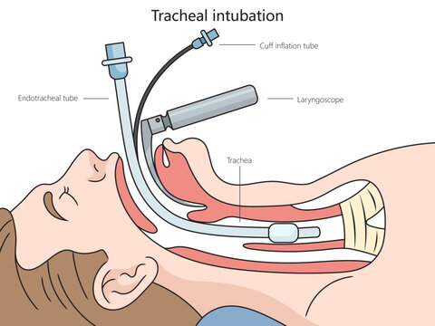 Diagram of tracheal intubation showing endotracheal tube and cuff placement